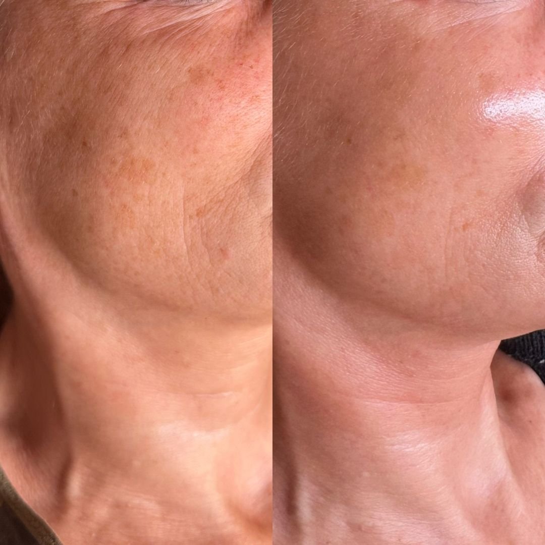Tratamiento Dermapen 4 + Exosomas