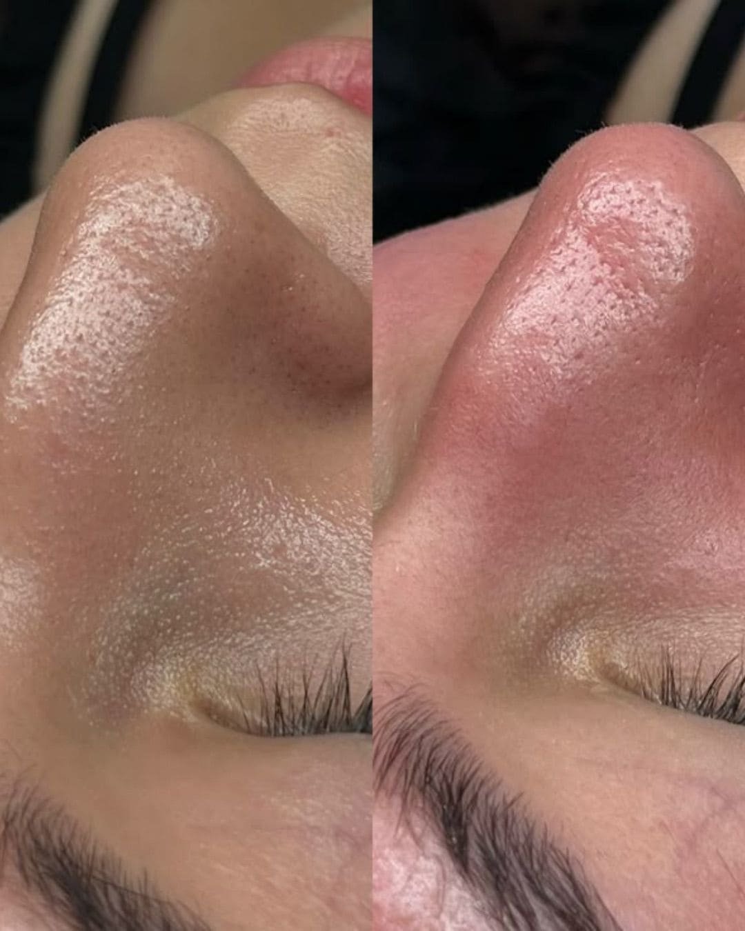 Tratamiento Hydrodiamond 