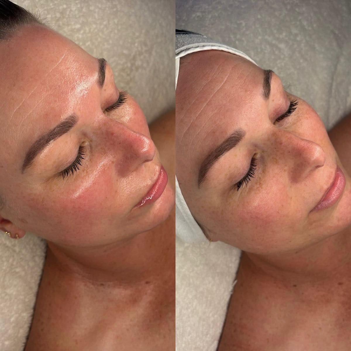 Tratamiento Hydrodiamond 