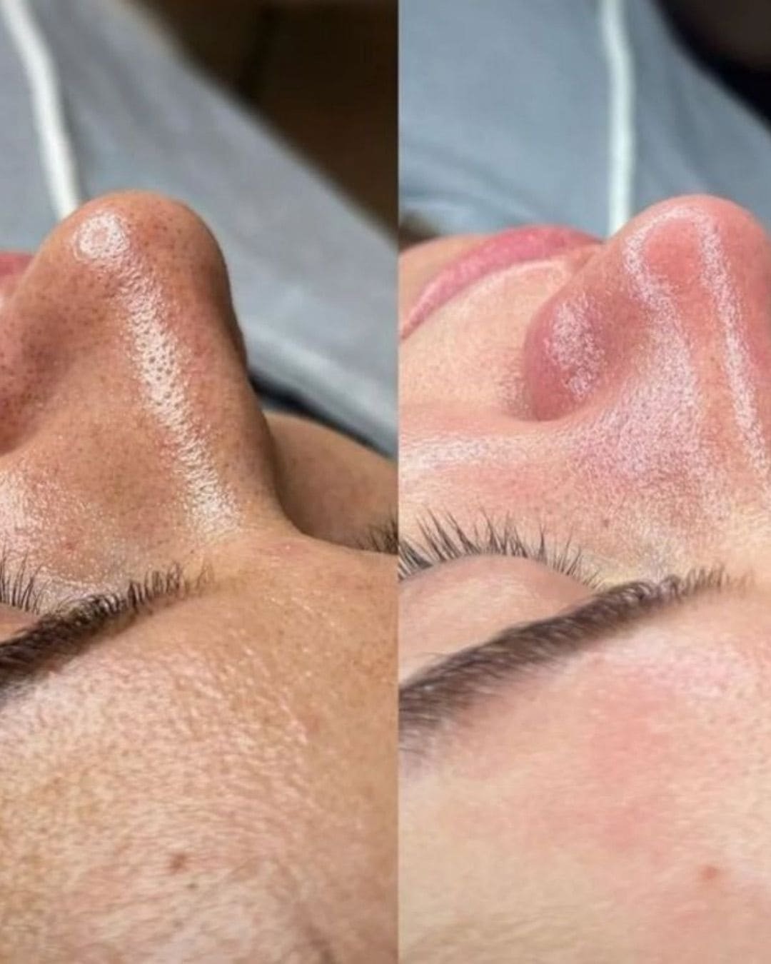 Tratamiento Hydrodiamond 