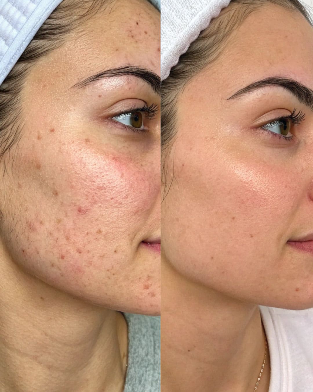 Bespoke Facial + Dermapen 4