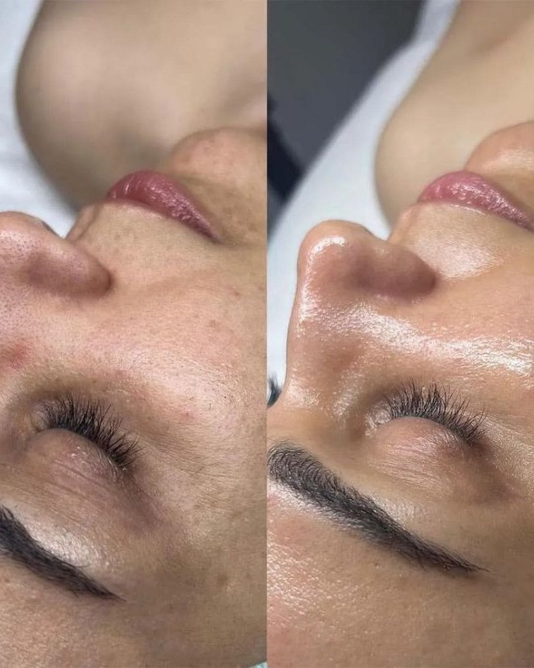 Tratamiento Hydrodiamond 