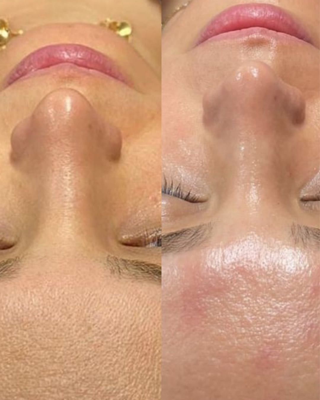 Tratamiento Hydrodiamond 