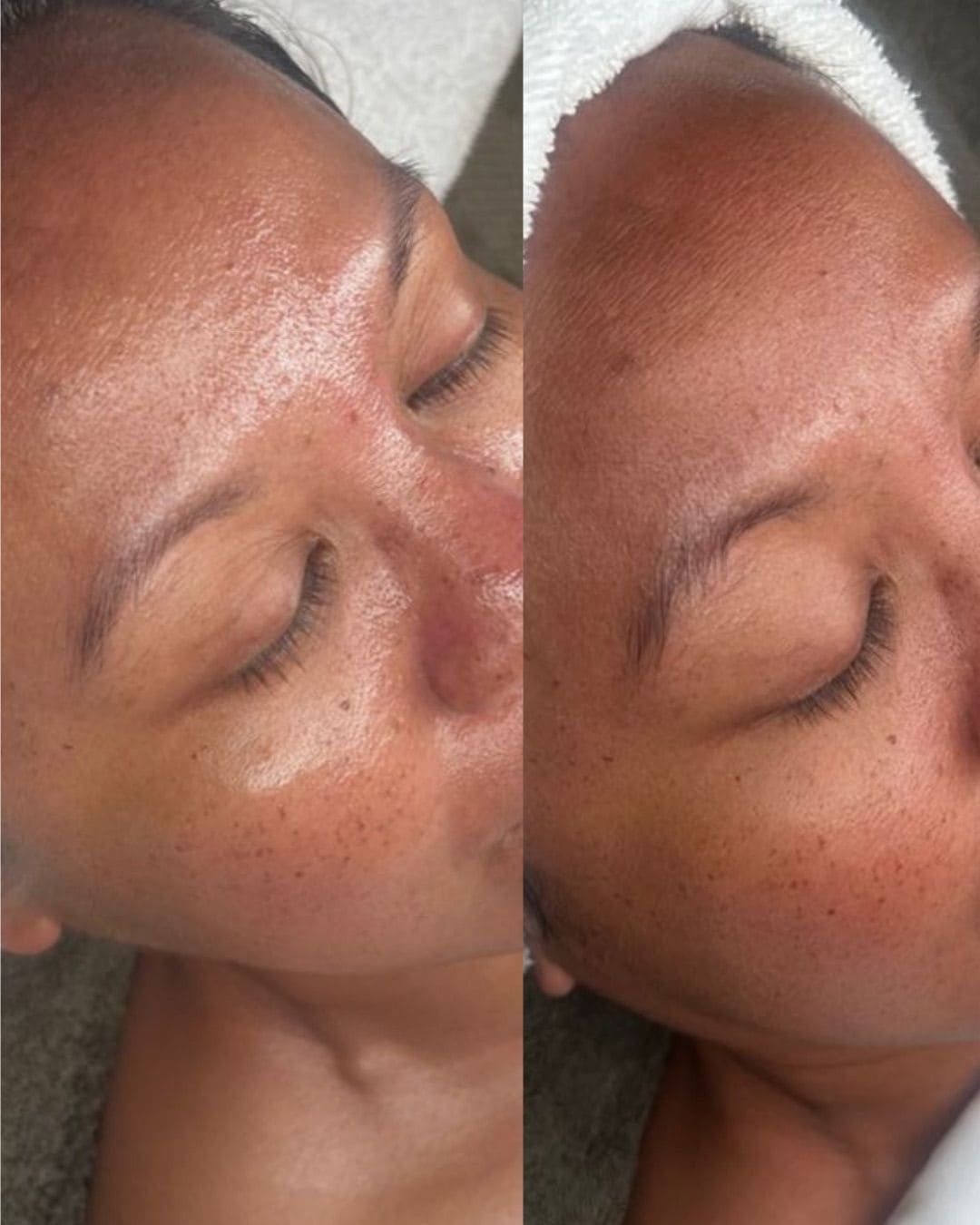 Tratamiento Hydrodiamond 