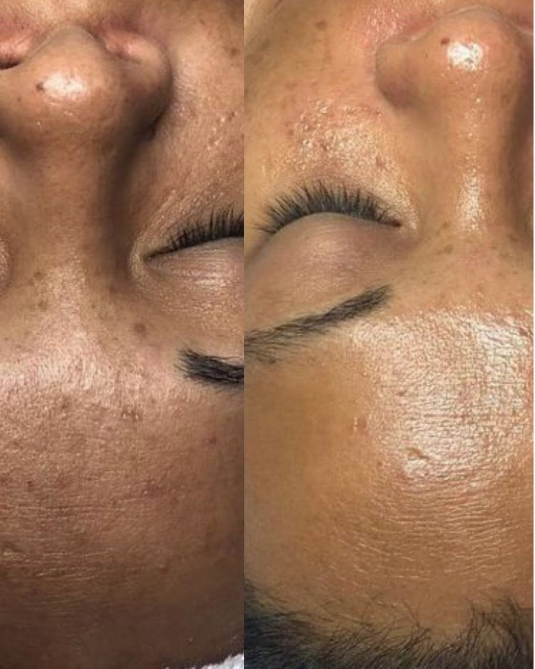 Bespoke Facial + Dermapen 4