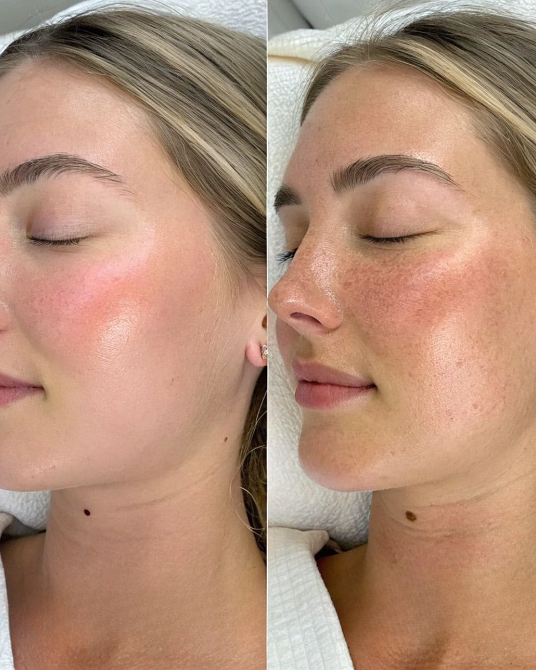 Tratamiento Hydrodiamond 