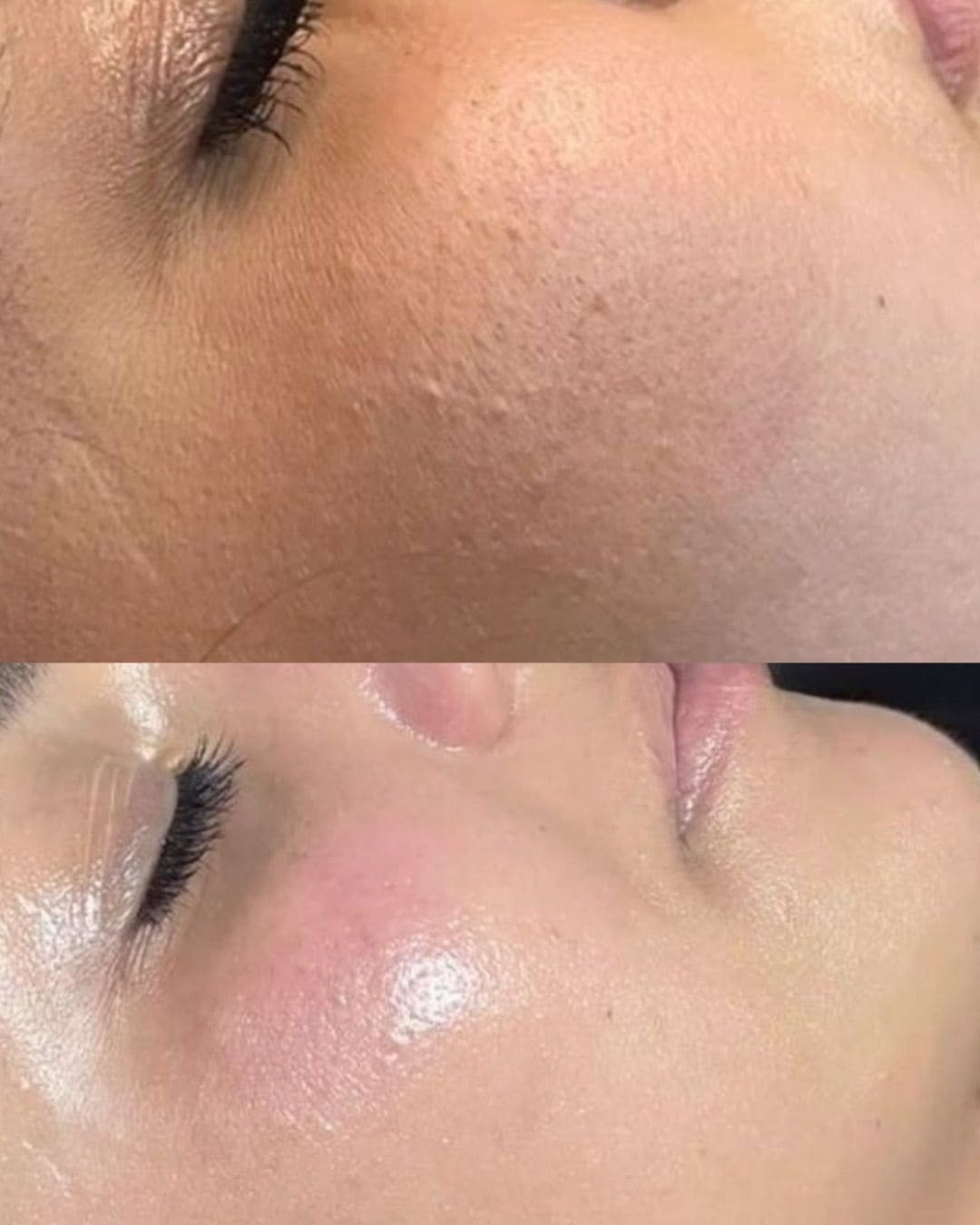 Tratamiento Hydrodiamond 