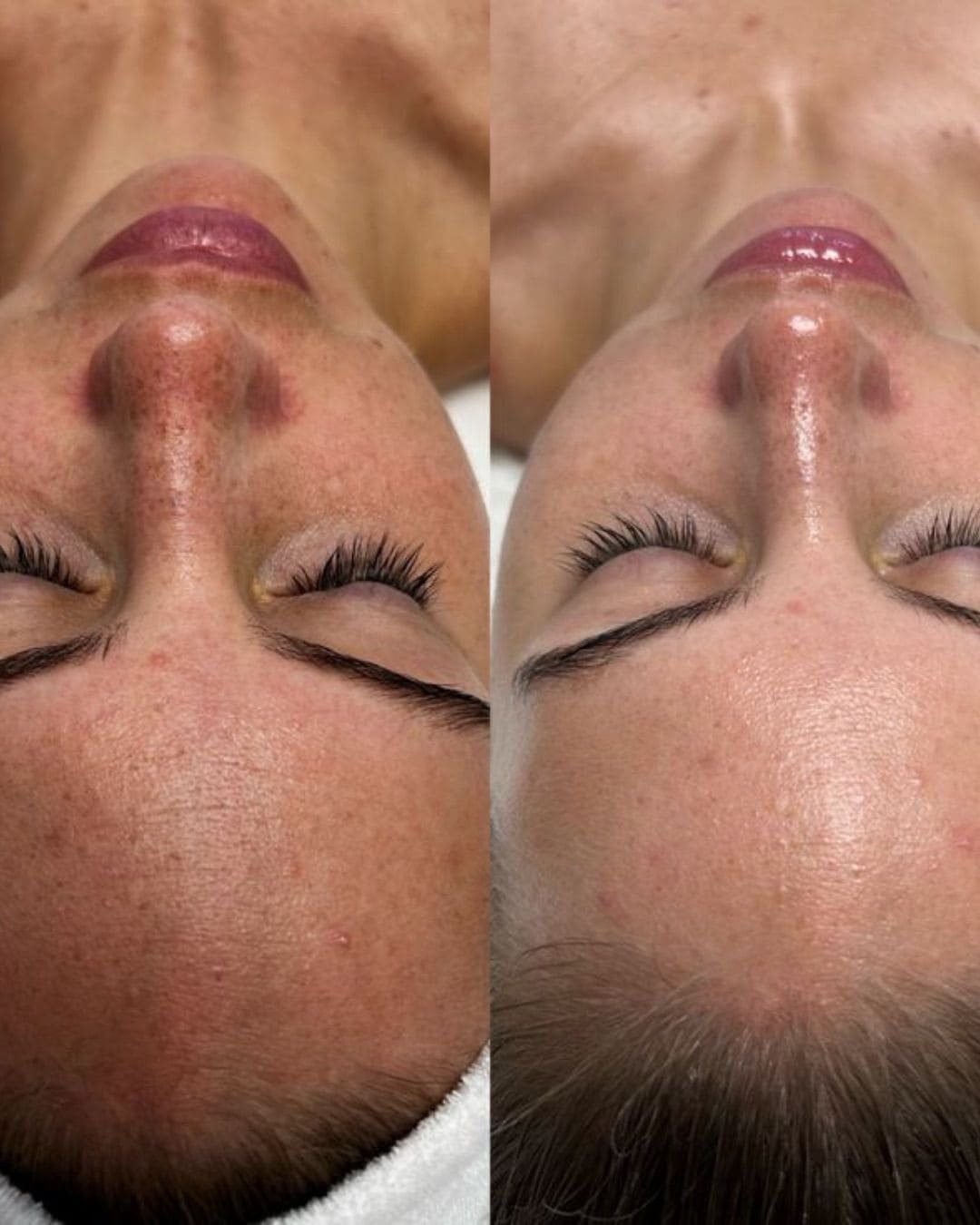 Tratamiento Hydrodiamond 