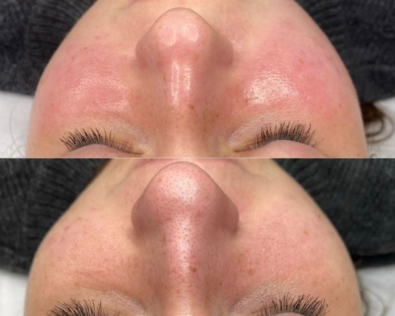 Tratamiento Hydrodiamond 